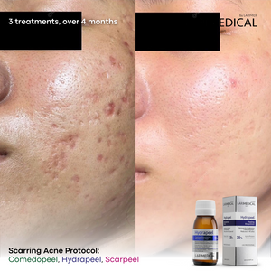 Opening Special: 3x Larimedical BioPeel Treatments In Studio