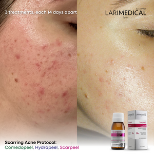 Opening Special: 3x Larimedical BioPeel Treatments In Studio