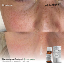 Load image into Gallery viewer, Opening Special: 3x Larimedical BioPeel Treatments In Studio